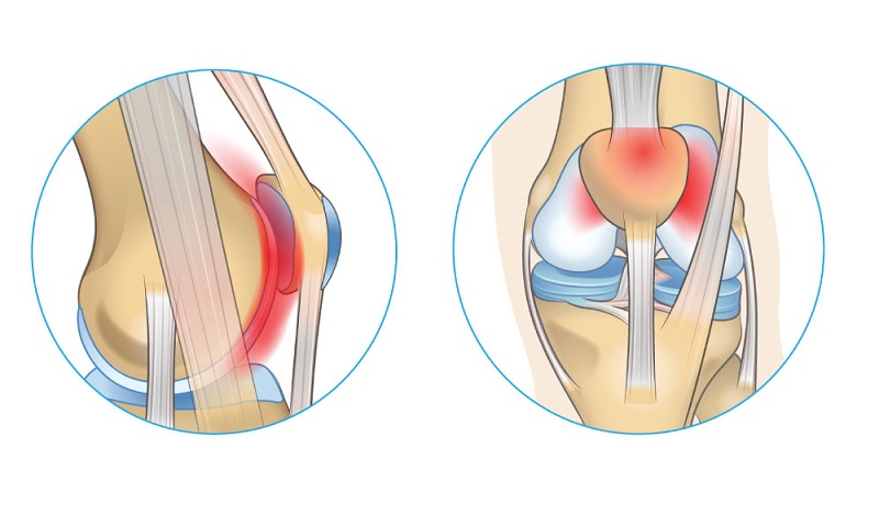پیشگیری از سائیدگی کشک زانو (Patellofemoral Osteoarthritis): جدیدترین روش‌ ها و استراتژی‌ ها