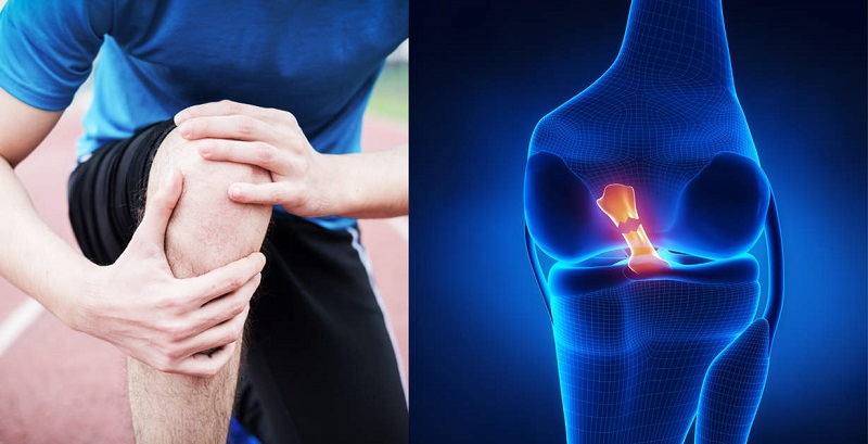 پارگی رباط صلیبی و مینیسک زانو؛ از تشخیص بالینی تا بازتوانی