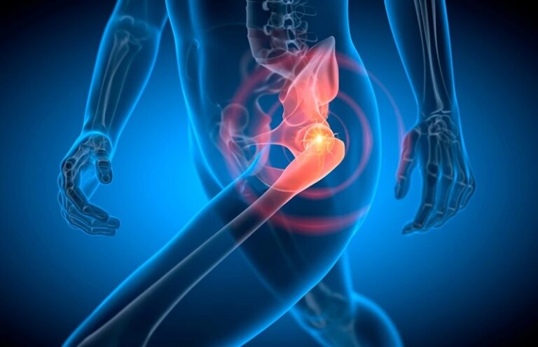 مقایسه تکنیک‌های مختلف در جراحی تعویض مفصل لگن