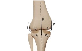 The Multifaceted Effects of Body Mass Index on Knee Wear