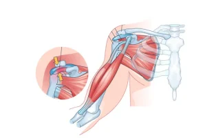 Rotator cuff repair